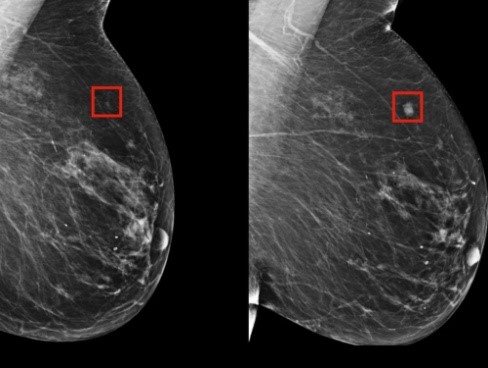 Breast Cancer Research